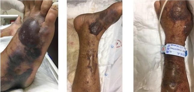 'Vi khuẩn ăn thịt người' từ biển tấn công nhiều người ảnh 1