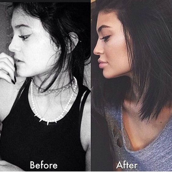 Tại sao mọi người đều tiêm filler làm đầy môi? Những khao khát dấu đằng sau mốt môi dày ảnh 3