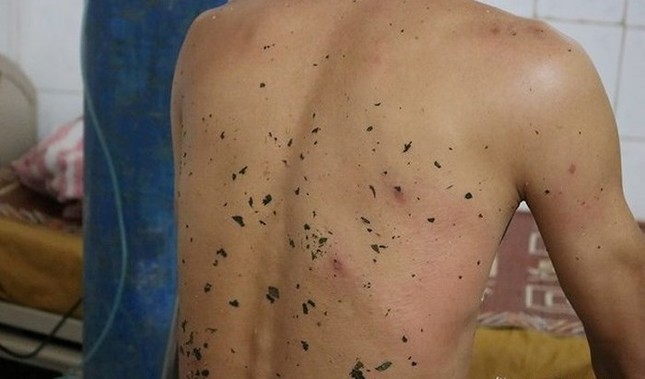 Bị ong vò vẽ đốt, 11 người thương vong ảnh 1