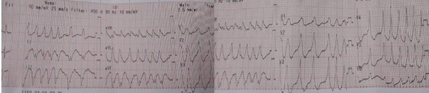 Cứu sống bệnh nhân 'thập tử nhất sinh' tim đập 300 lần/phút ảnh 1