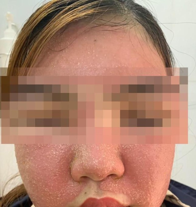 Mặt mũi sưng phù vì đắp mặt nạ làm đẹp da bằng đông y ảnh 1
