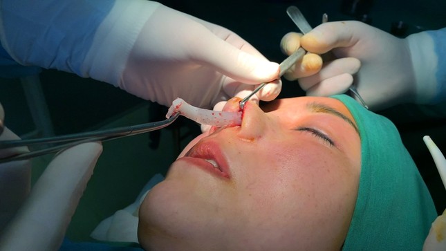 Nâng mũi ở spa, được 'khuyến mãi' thêm ổ áp-xe mông ảnh 3