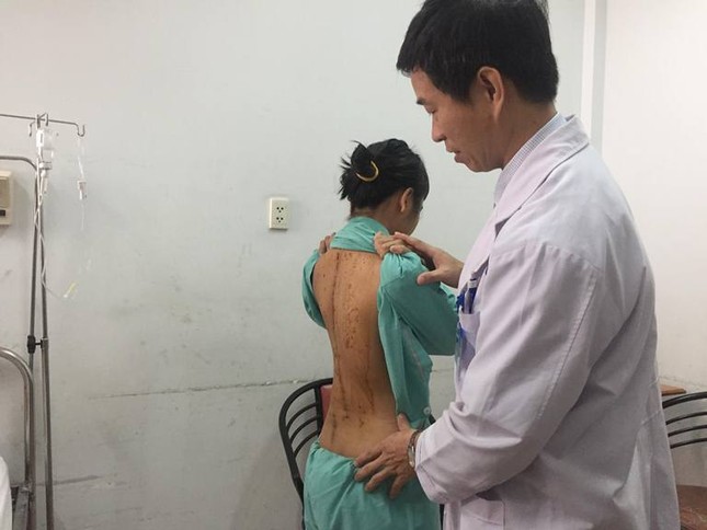 Sau phẫu thuật vẹo cột sống, thiếu nữ tăng 7 cm chiều cao ảnh 4