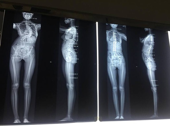 Sau phẫu thuật vẹo cột sống, thiếu nữ tăng 7 cm chiều cao ảnh 2