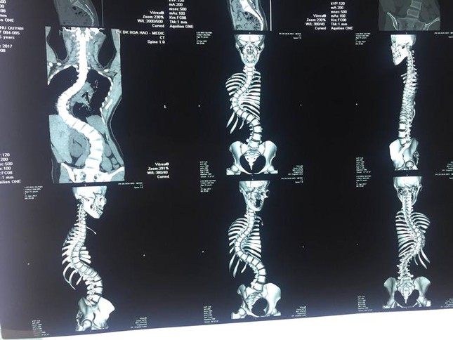 Sau phẫu thuật vẹo cột sống, thiếu nữ tăng 7 cm chiều cao ảnh 3