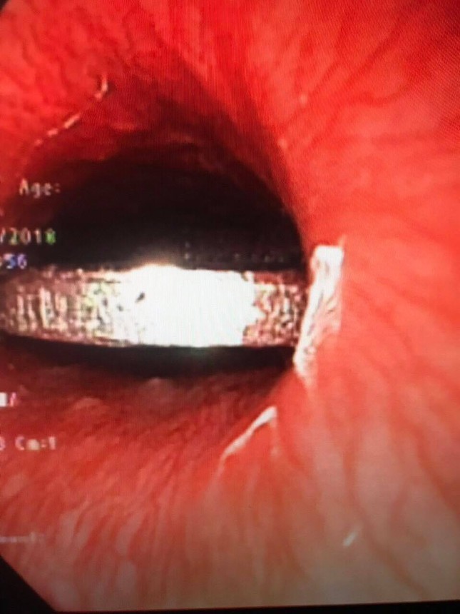 Bàng hoàng phát hiện đồng xu nằm trong thực quản bé gái 5 tuổi ảnh 2