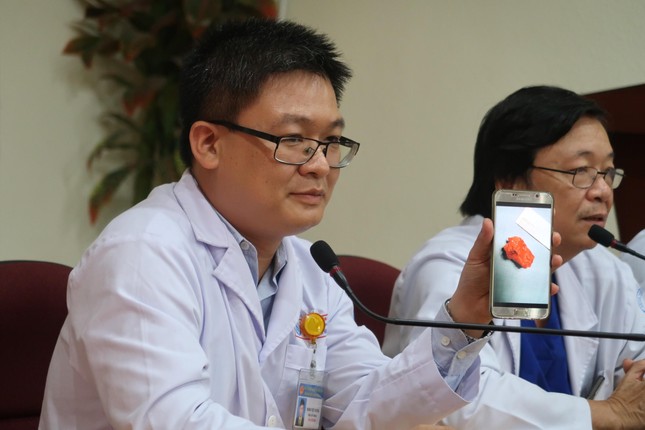 Ho kéo dài không khỏi, bé gái suýt chết vì khối bướu hiếm gặp ảnh 1
