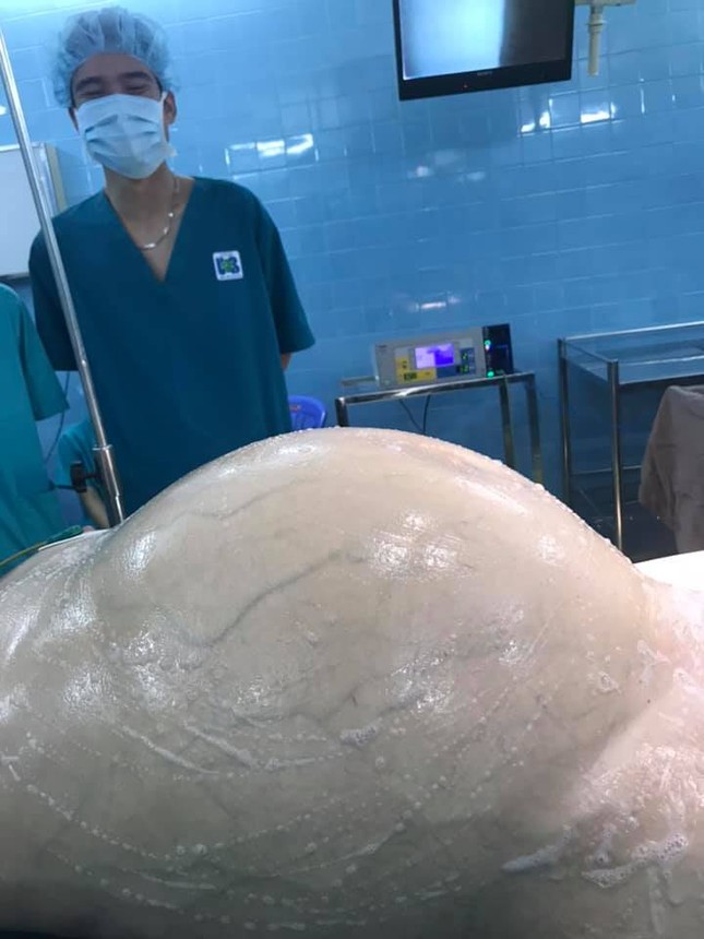 Choáng với khối u khủng nặng 25 kg trong ổ bụng bệnh nhân ảnh 1