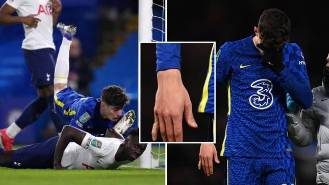 Ngôi sao Chelsea gãy ngón tay sau khi ghi bàn, cắn răng thi đấu hết hiệp 1 ảnh 1
