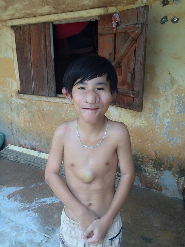 Cậu bé “Trư Bát Giới” và gần chục lần lên bàn mổ ảnh 1