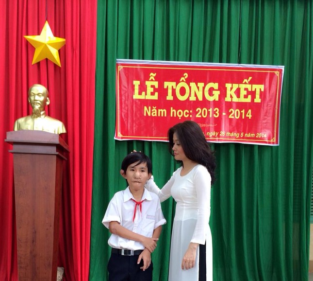 Cậu bé “Trư Bát Giới” và gần chục lần lên bàn mổ ảnh 3