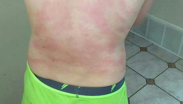 Lạ lùng cậu bé khắp người nổi ngứa vì dị ứng nước mắt ảnh 1