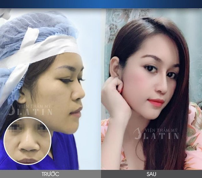 Hoàn thiện nhan sắc với công nghệ nâng mũi cấu trúc dáng LATIN ảnh 1