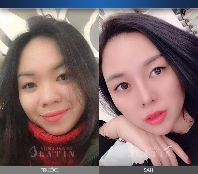 Hoàn thiện nhan sắc với công nghệ nâng mũi cấu trúc dáng LATIN ảnh 2