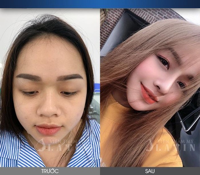 Hoàn thiện nhan sắc với công nghệ nâng mũi cấu trúc dáng LATIN ảnh 3