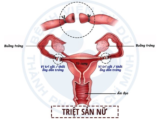 Các biện pháp tránh thai ưu việt hiện nay ảnh 3