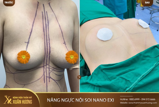 Giảm 50% nâng ngực nội soi NANO EXI tại Bệnh viện thẩm mỹ Xuân Hương ảnh 3