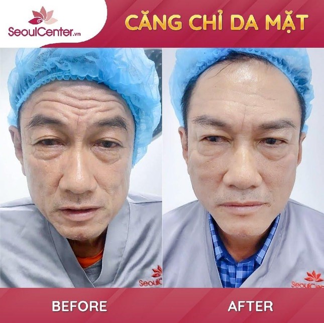 SeoulCenter.Vn ưu đãi cực hot 'mua 1 tặng 1' dịch vụ căng chỉ Collagen ảnh 4