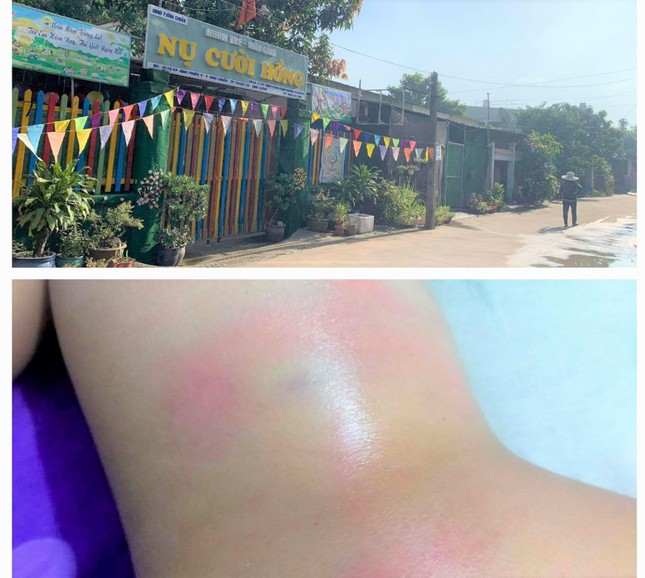 Bé gái 4 tuổi nghi bị cô giáo đánh bầm tím vì đi vệ sinh trong quần ảnh 1