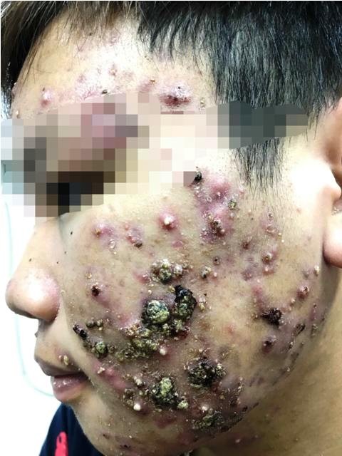 Thiếu nữ 19 tuổi mặt 'nát nhừ' vì dùng kem dưỡng da mua trên mạng ảnh 1