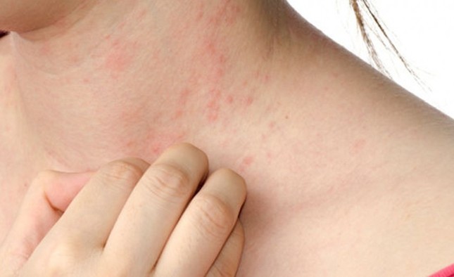 Bị dị ứng thế này khi trời lạnh có thể tử vong ảnh 1