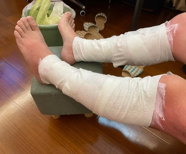 Một người Đài Loan bị bỏng nặng vì bật đèn UV diệt khuẩn trong phòng suốt 3 tiếng ảnh 1