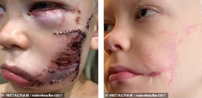 “Siêu anh hùng nhí" cứu em gái khỏi chó cắn được nhóm bác sĩ tình nguyện chữa sẹo miễn phí ảnh 4