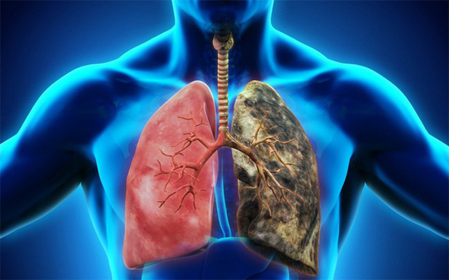 Những người cực dễ bị ung thư phổi ‘tấn công’ dù không hút thuốc ảnh 1