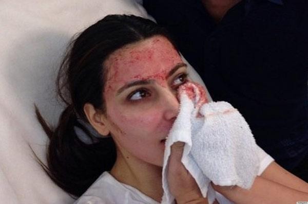 4 phương pháp làm đẹp đau đớn của Kim Kardashian: "Mặt nạ ma cà rồng" gây khiếp sợ ảnh 3