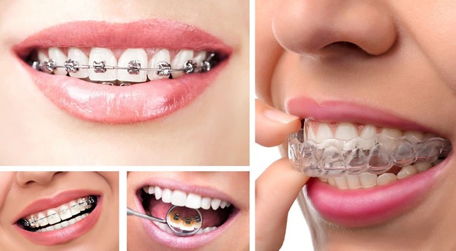 “Không thể để răng xấu suốt kiếp" - niềng răng không phiền phức như bạn tưởng! ảnh 2