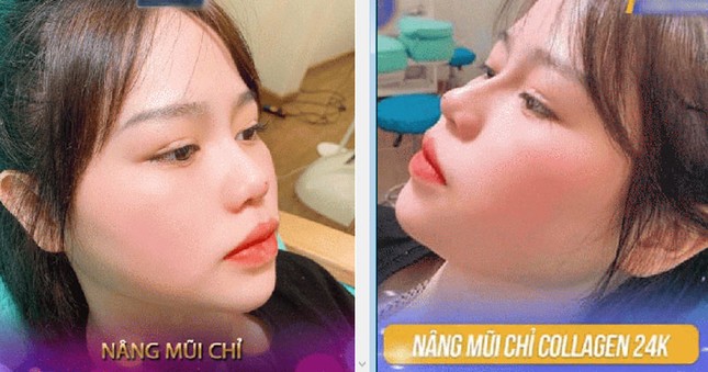 Bạn gái Quang Hải lên tiếng khi dân mạng truyền nhau ảnh cô nàng đi nâng mũi và sửa mặt ảnh 1