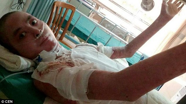 Cảm động hai em bé hiến da đầu cứu cha bỏng nặng ảnh 1