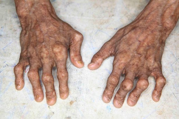 Bé trai 14 tuổi già như ông lão vì mắc bệnh lạ ảnh 2