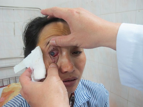 Đang buộc đồ, dây chun bất ngờ đứt bắn mù mắt ảnh 1