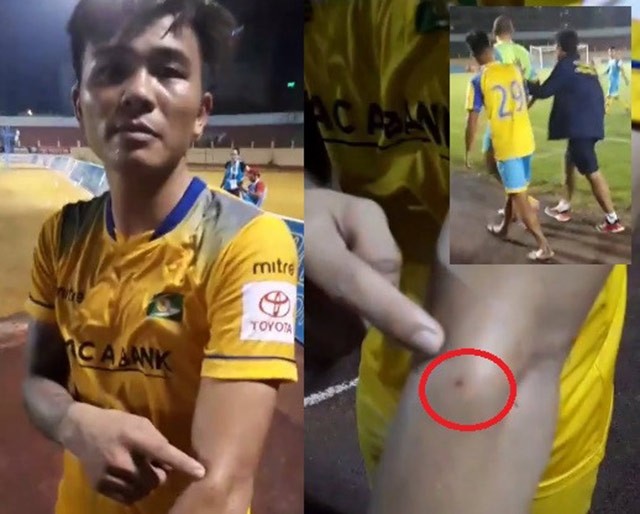 V.League tái hiện vụ Suarez cắn tay Ivanovic ảnh 1