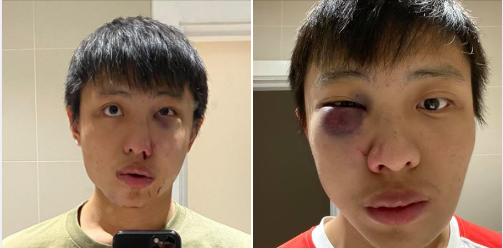 Trong "tâm bão" virus corona, nạn phân biệt chủng tộc bùng nổ nhắm vào người châu Á ảnh 2