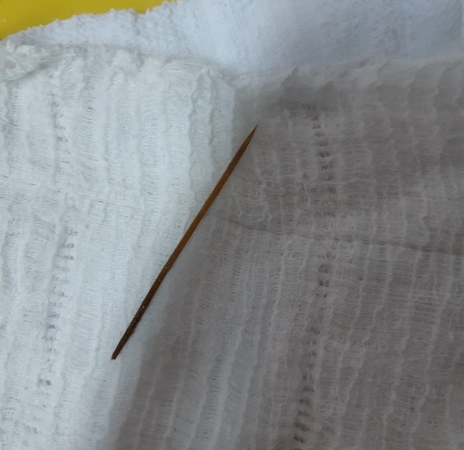 Người đàn ông ngủ quên, nuốt que tăm dài 6cm vào bụng - ảnh 2
