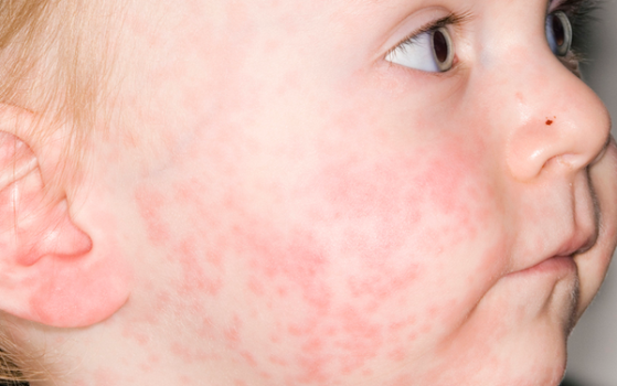 Làm sao để kiểm soát các bệnh ngoài da do virus - ảnh 2