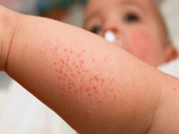 Những loại thuốc 'uống là chết' khi bị sốt xuất huyết - ảnh 2