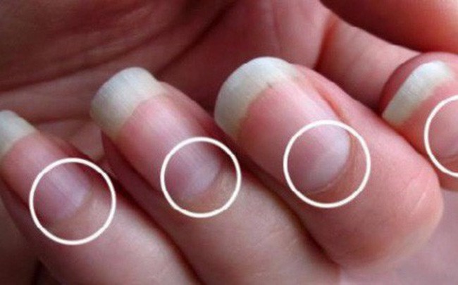 Những dấu hiệu từ móng tay cảnh báo ung thư hoặc gan 'sắp hỏng' - ảnh 2