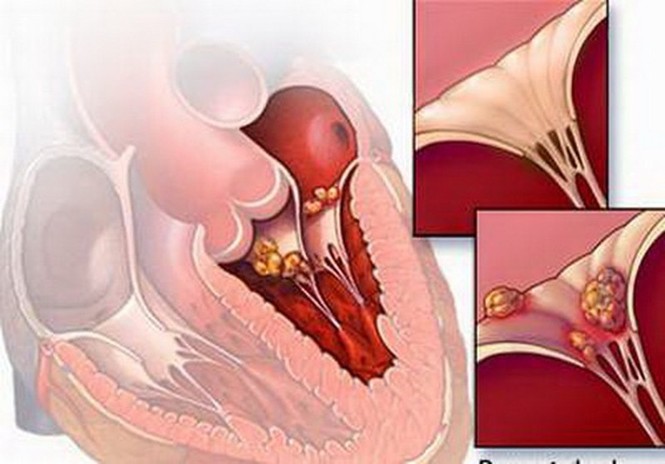 Bác sĩ nói gì về thông tin viêm cơ tim gây tử vong 'nhanh hơn điện' - ảnh 1