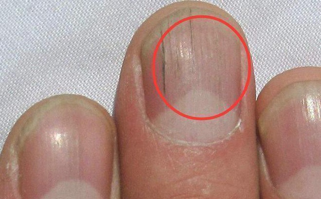 Có dấu hiệu này, đi khám ung thư gan ngay kẻo 'hối không kịp' - ảnh 2