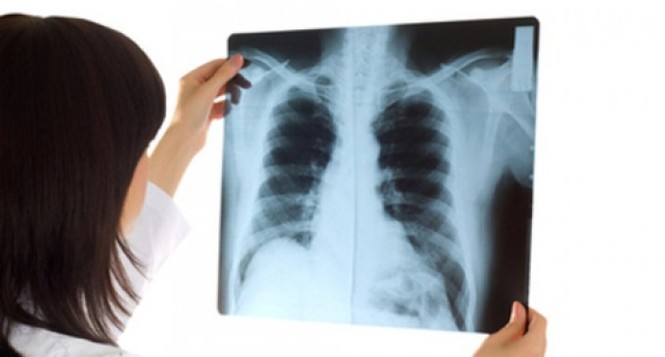 Những dấu hiệu sớm để phát hiện 5 bệnh ung thư nhiều người Việt mắc nhất - ảnh 2