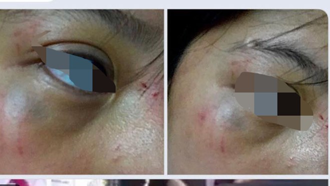 Bị nhóm bạn quây đánh hội đồng, nữ sinh lớp 8 ở Thanh Hoá phải nhập viện - ảnh 3