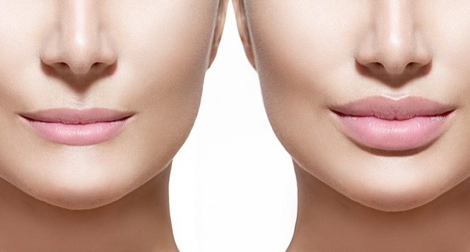Tại sao mọi người đều tiêm filler làm đầy môi? Những khao khát dấu đằng sau mốt môi dày - ảnh 2