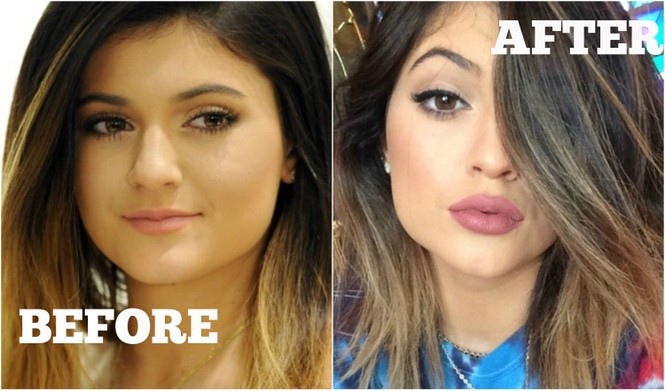 Tại sao mọi người đều tiêm filler làm đầy môi? Những khao khát dấu đằng sau mốt môi dày - ảnh 4