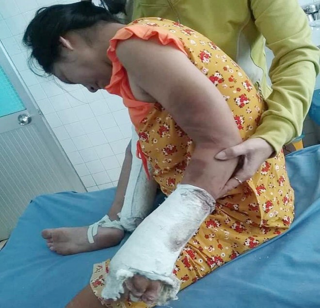 Thai phụ bị người tình đánh gãy tay chân - ảnh 1