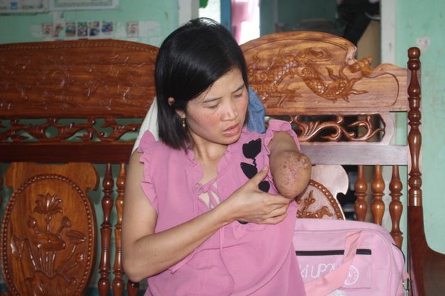 Xót xa cảnh cô giáo mất đi cánh tay trong lần băng rừng 'gieo chữ' - ảnh 1