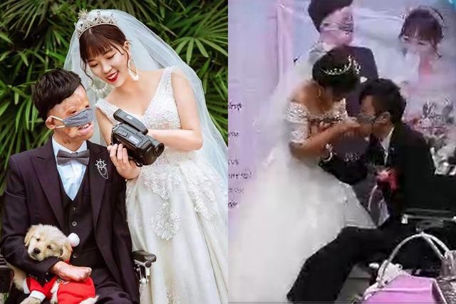 Cổ tích tình yêu đời thực của chàng trai bị bỏng hủy dung 85% - ảnh 1