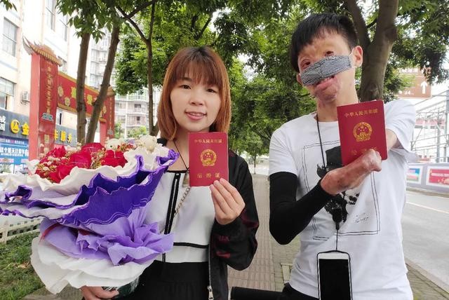 Cổ tích tình yêu đời thực của chàng trai bị bỏng hủy dung 85% - ảnh 4